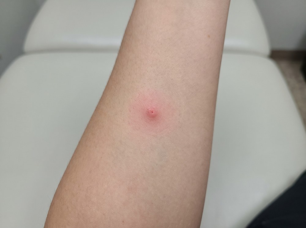 Close-up of a mild crab spider bite mark showing a small pink puncture with faint redness and no blistering