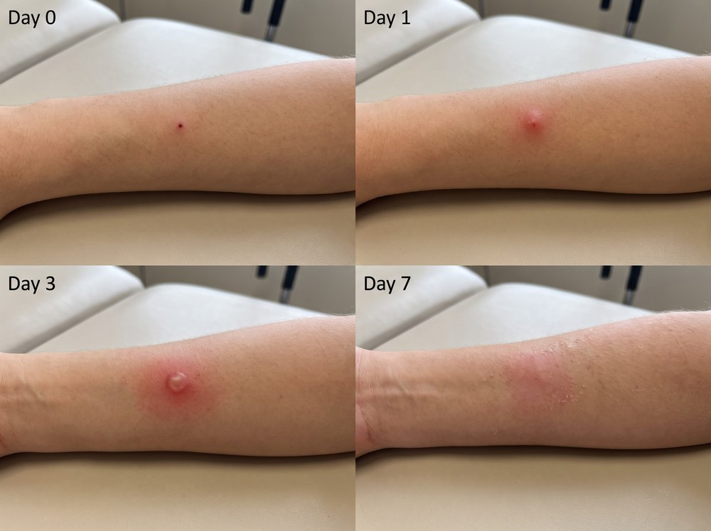 Side-by-side labeled comparison of a faint crab spider bite mark and a more visible wolf spider bite with fang marks
